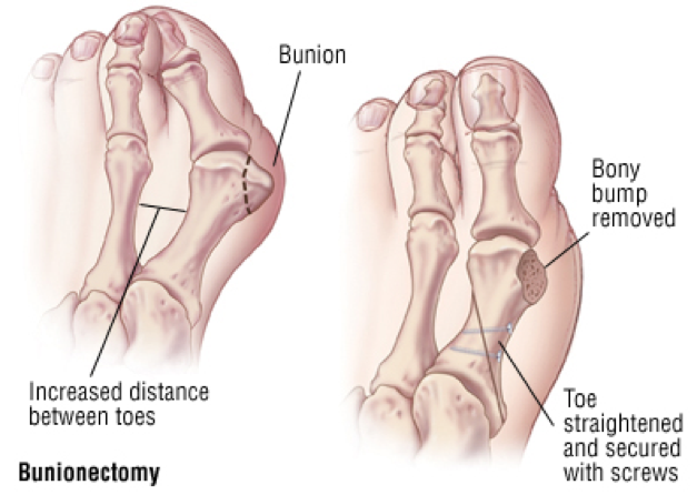 Bunions Cal Sports Orthopaedic Institute Orthopaedic Specialists In Berkeley Orinda