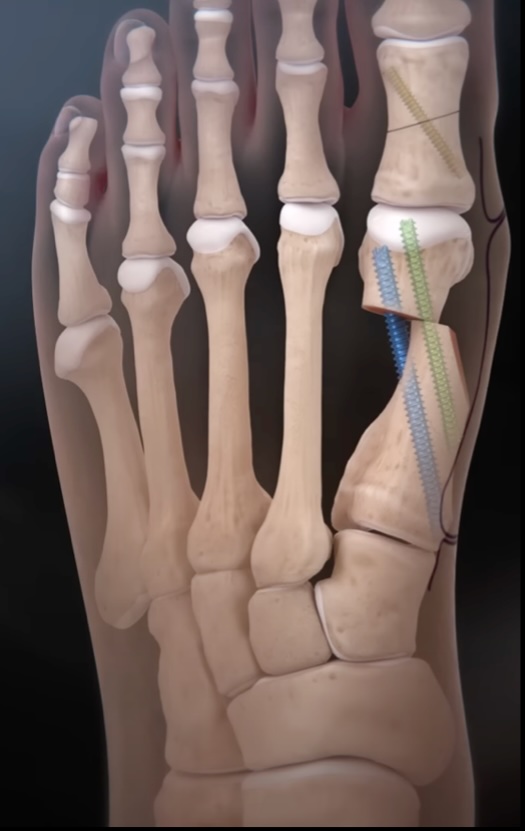 Minimal Incision Surgery for Bunions | Cal Sports & Orthopaedic ...