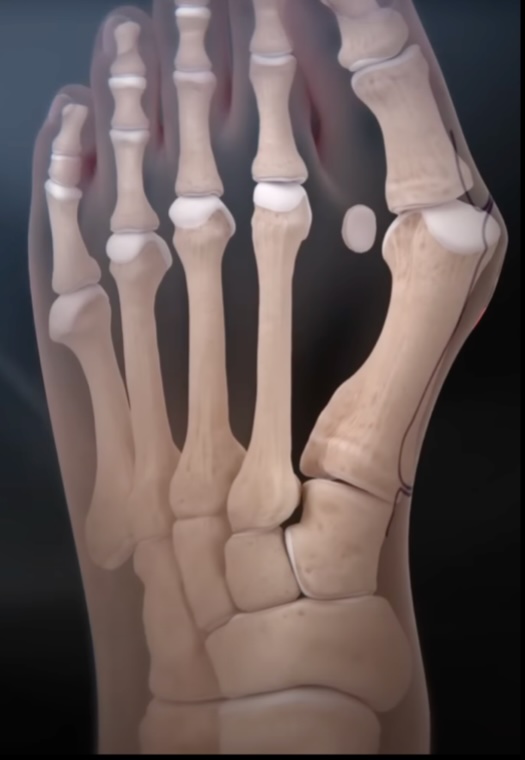 Minimal Incision Surgery For Bunions Cal Sports Orthopaedic Institute Orthopaedic